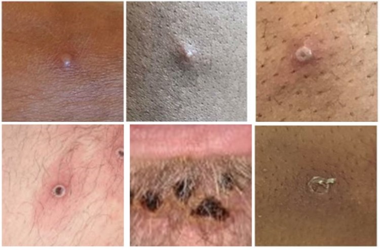 Photos of mpox