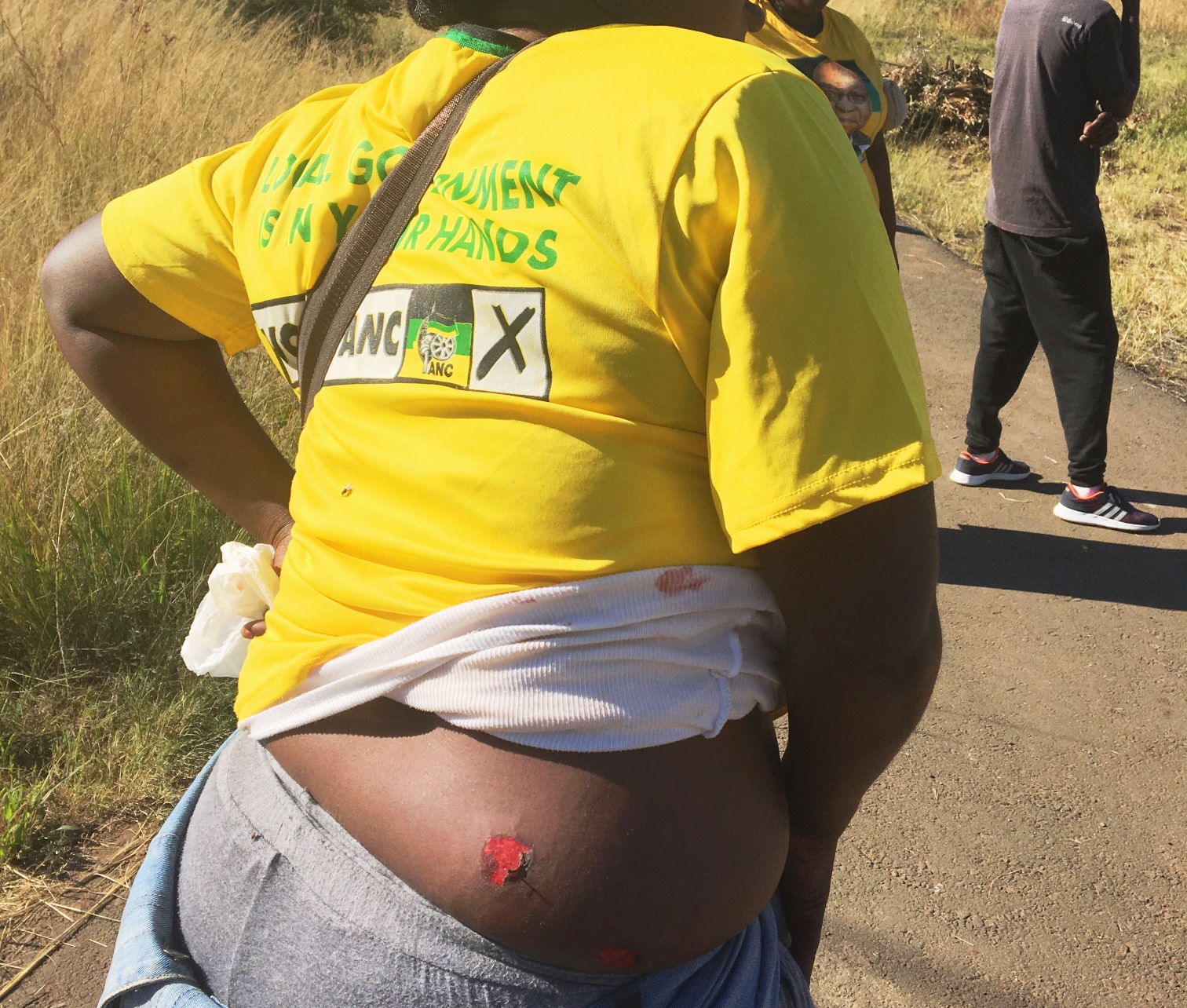 Photo of a woman showing two wounds